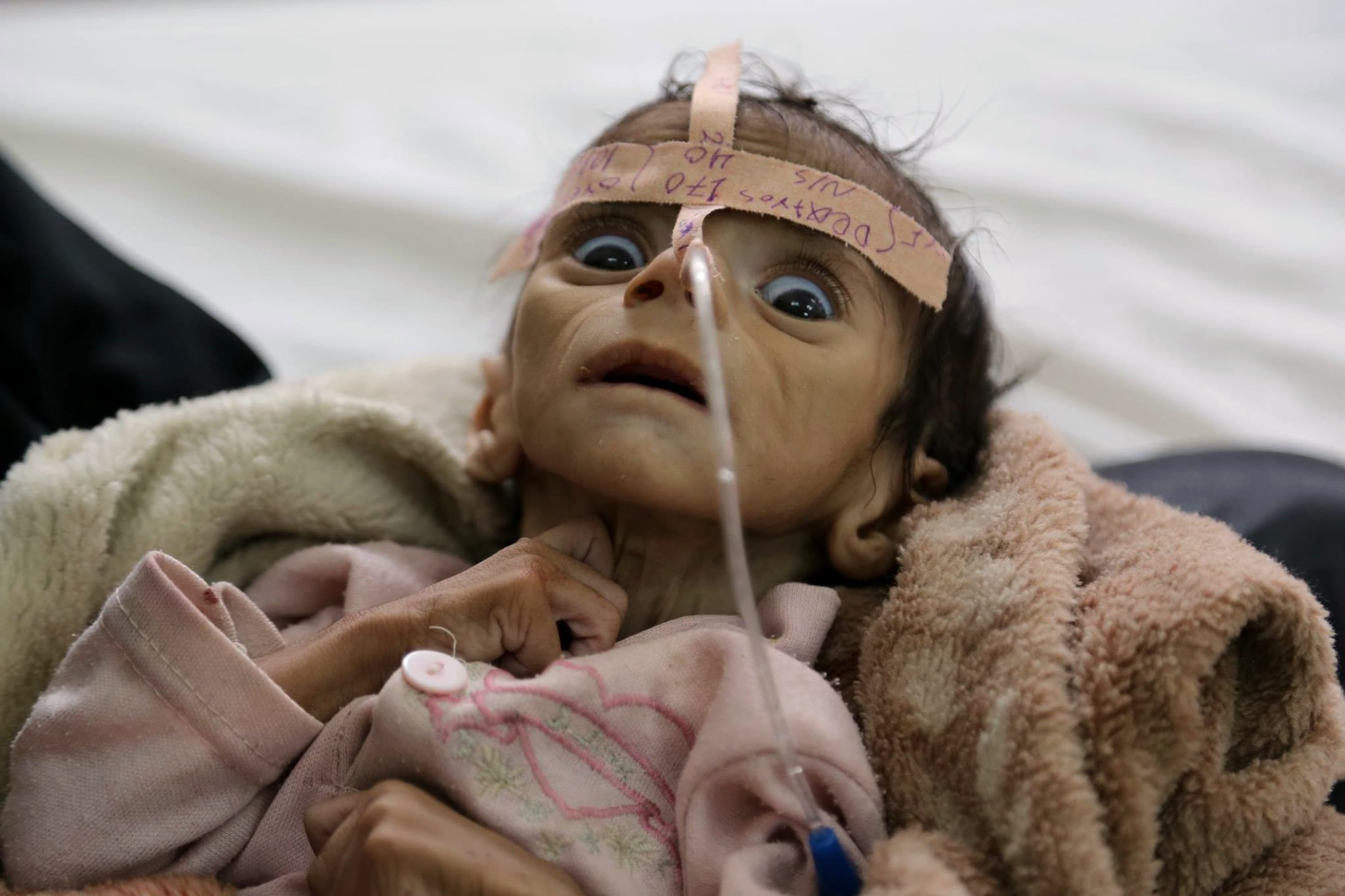 Yemen Hunger War: A man made famine on our watch - Bergensia